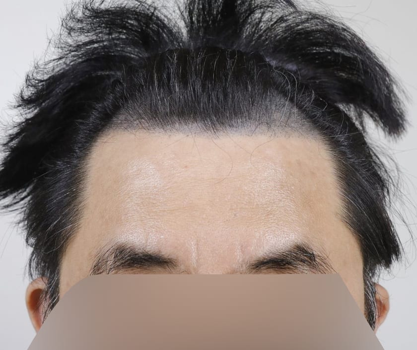 BEFORE 남성 · 절개 3,300모 · 헤어라인