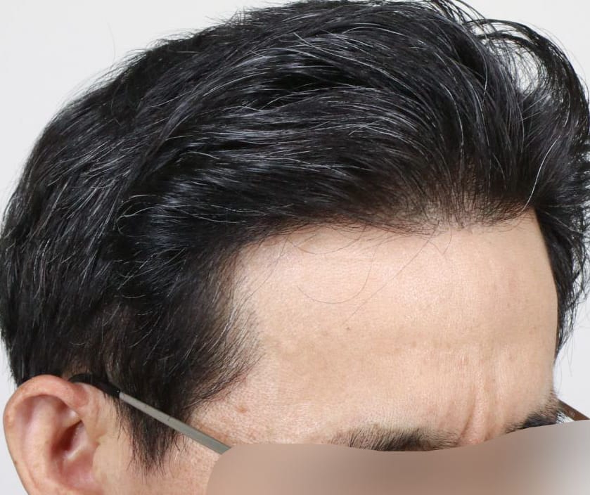 AFTER 남성 · 절개 3,500모 · 헤어라인