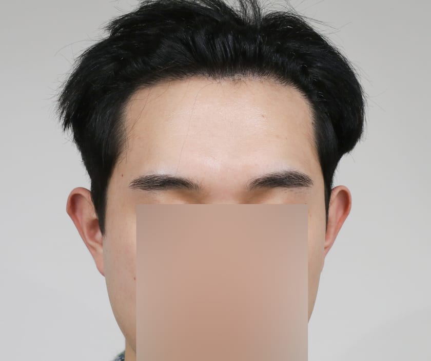AFTER 남성 · 절개 3,500모 · 헤어라인 · 관자놀이