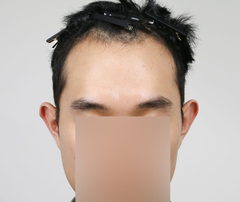 BEFORE 남성 · 절개 3,500모 · 헤어라인 · 관자놀이