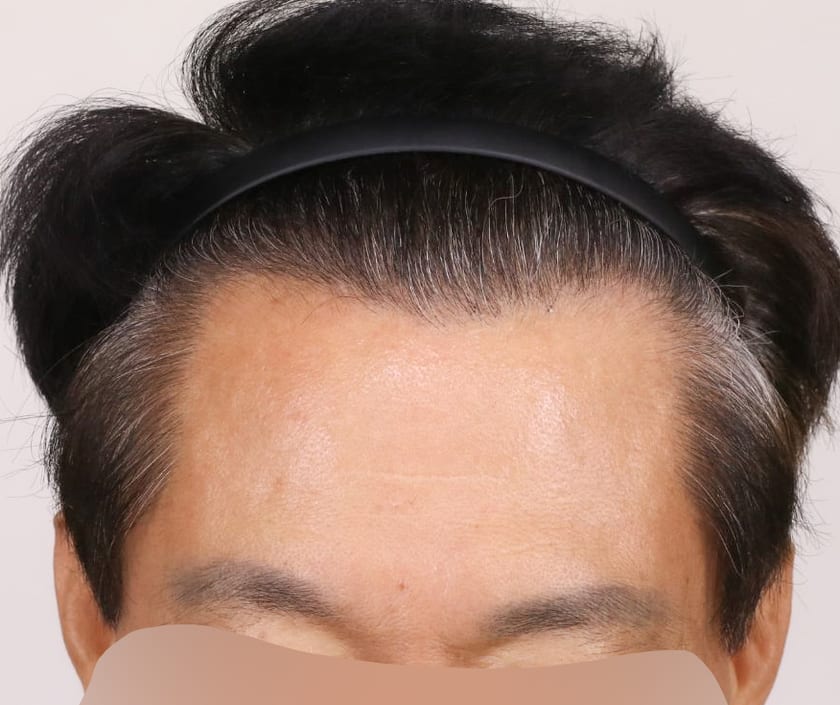 AFTER 남성 · 절개 3,500모 · 헤어라인 · 관자놀이