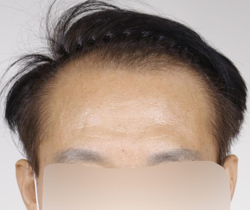 BEFORE 남성 · 절개 3,500모 · 헤어라인 · 관자놀이