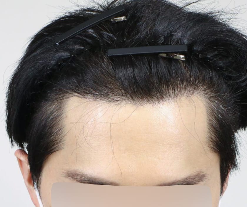 AFTER 남성 · 절개 3,700모 · 헤어라인 · 관자놀이