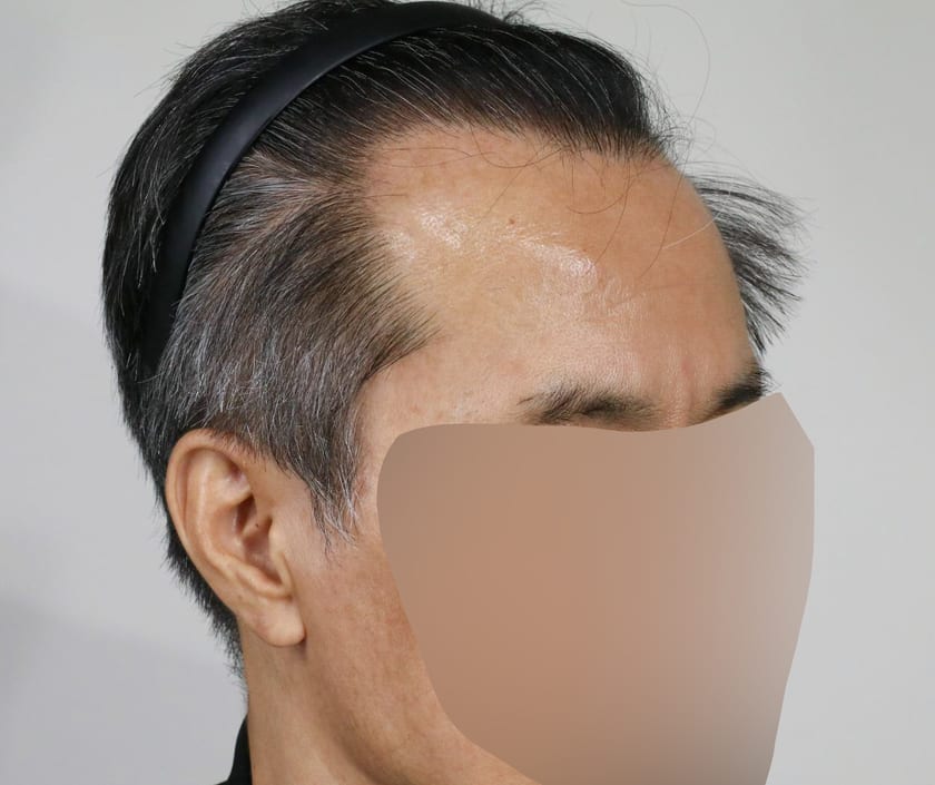 AFTER 남성 · 절개 4,000모 · 헤어라인 · 앞정수리