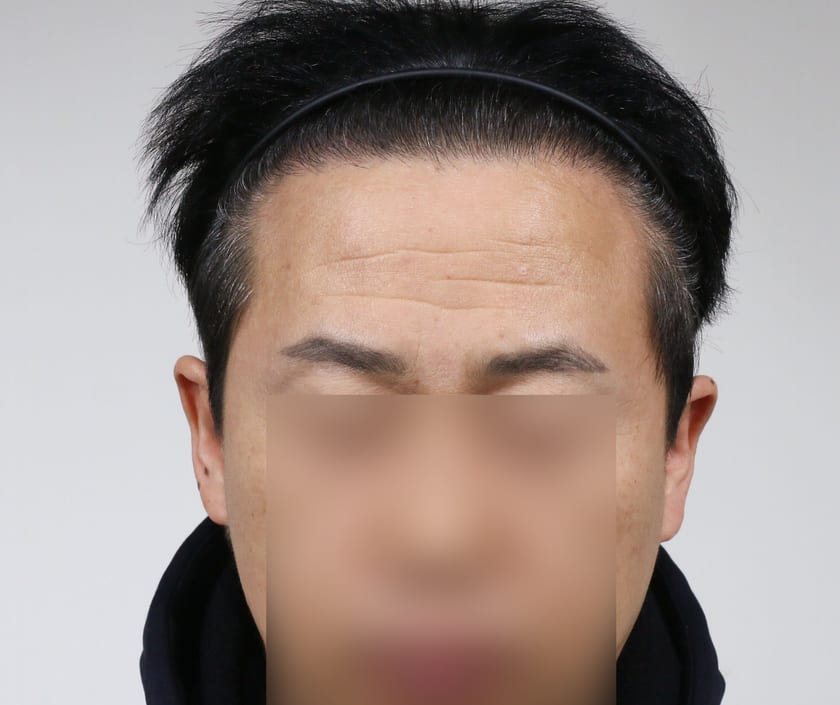 AFTER 남성 · 절개 4,000모 · 헤어라인 · 정수리