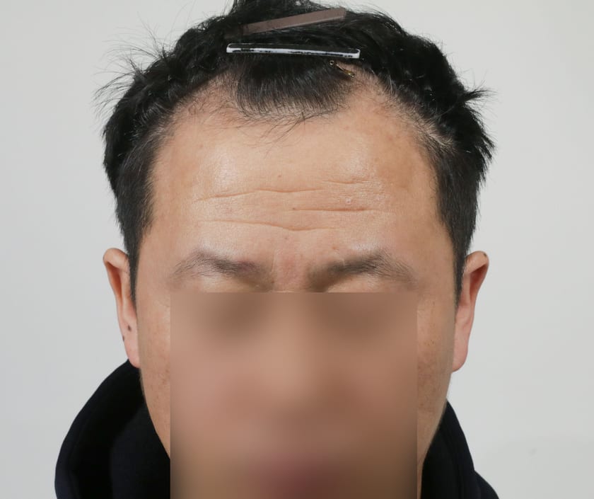 BEFORE 남성 · 절개 4,000모 · 헤어라인 · 정수리