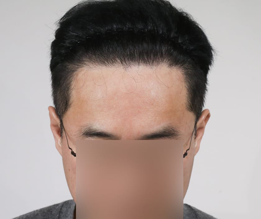 AFTER 남성 · 절개 + 비절개 4,000모 · 헤어라인