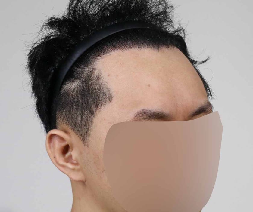 AFTER 남성 · 절개 4,000모 · 헤어라인 · 관자놀이