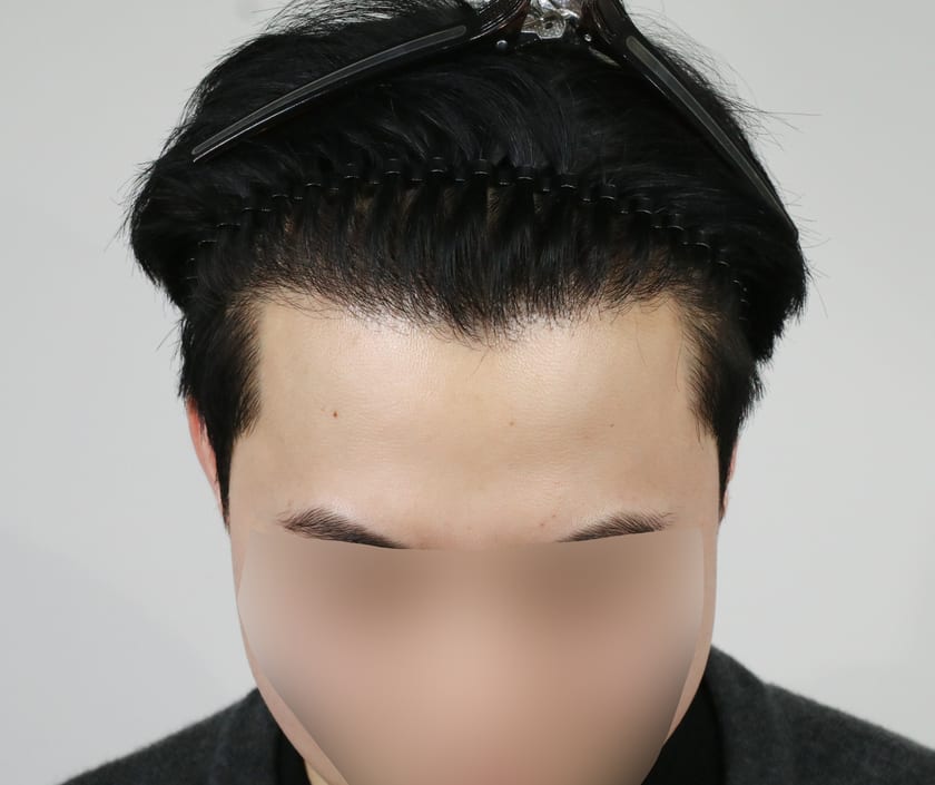 AFTER 남성 · 절개 4,500모 · 헤어라인 · 관자놀이