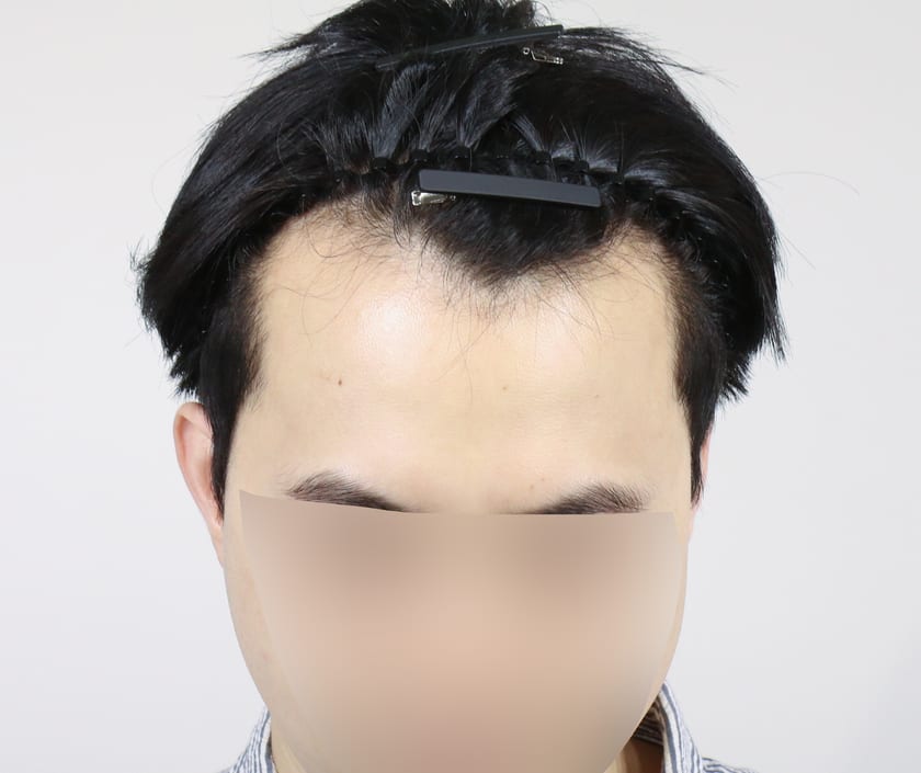 BEFORE 남성 · 절개 4,500모 · 헤어라인 · 관자놀이
