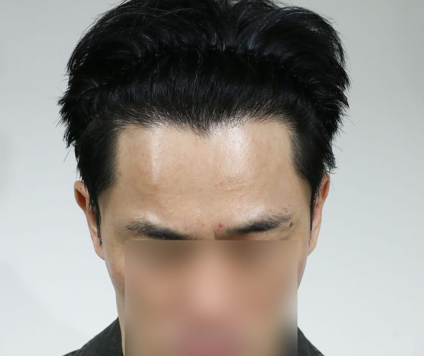 AFTER 남성 · 절개 4,500모 · 헤어라인 · 관자놀이 · 가마