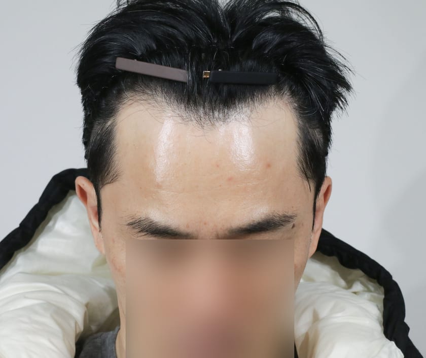 BEFORE 남성 · 절개 4,500모 · 헤어라인 · 관자놀이 · 가마