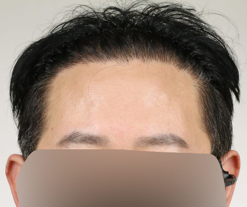 AFTER 남성 · 절개 5,000모 · 헤어라인