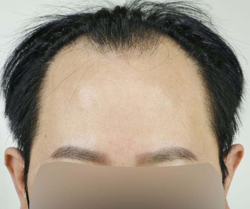 BEFORE 남성 · 절개 5,000모 · 헤어라인