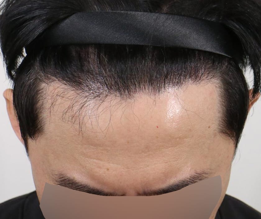 AFTER 남성 · 절개 5,000모 · 헤어라인 · 관자놀이