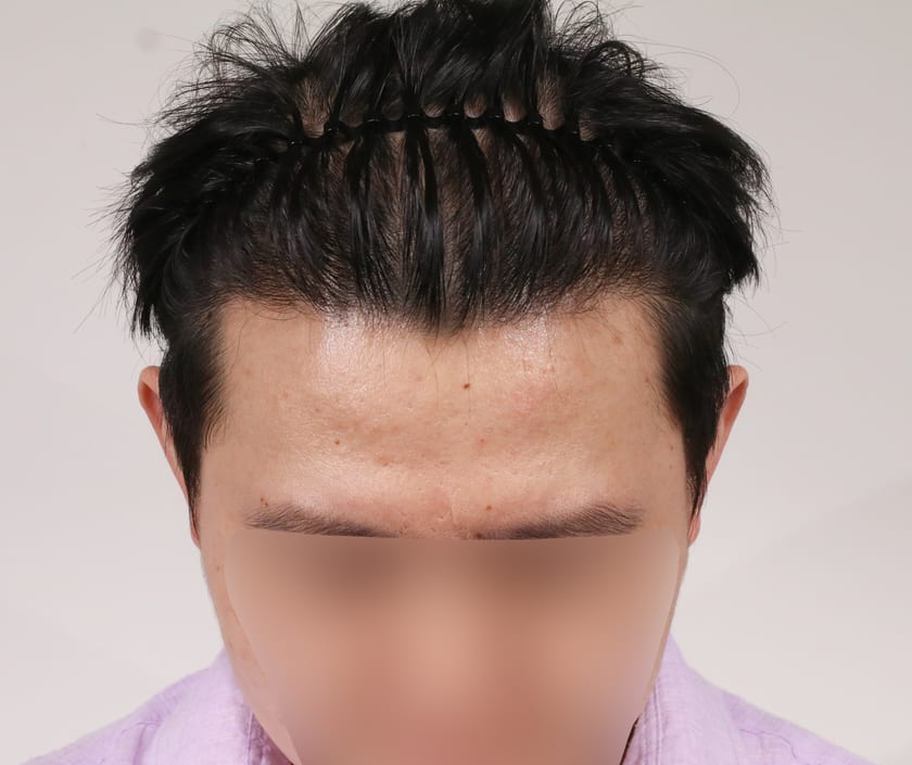AFTER 남성 · 절개 5,500모 · 헤어라인 · 앞정수리