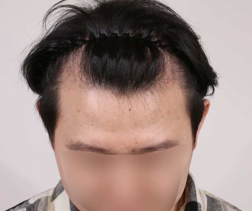 BEFORE 남성 · 절개 5,500모 · 헤어라인 · 앞정수리
