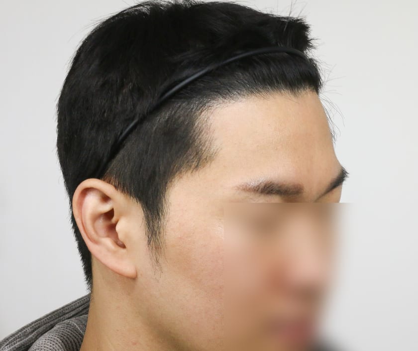 AFTER 남성 M자 · 구레나룻