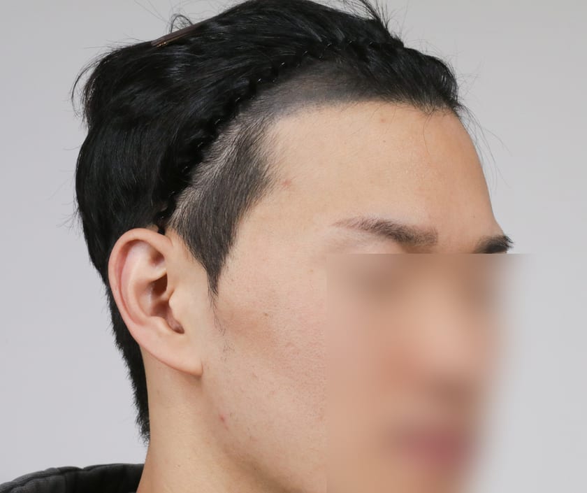BEFORE 남성 M자 · 구레나룻
