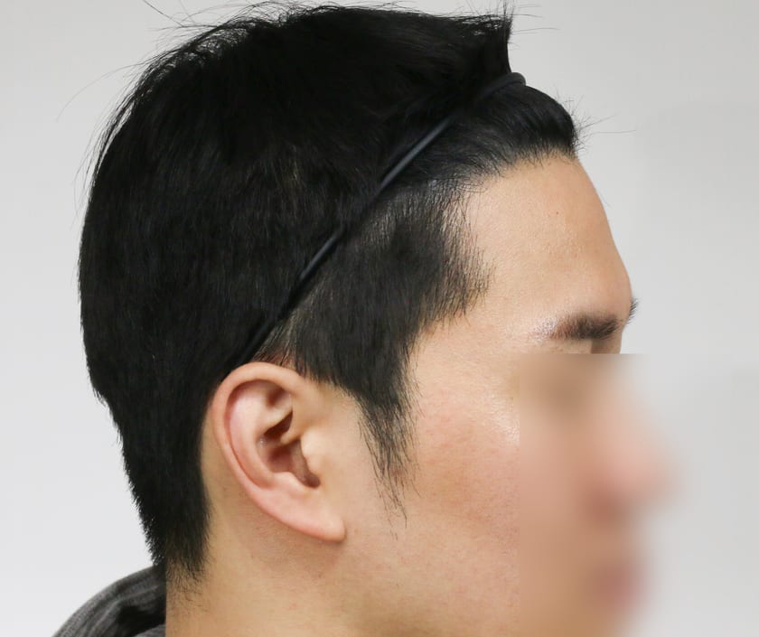 AFTER 남성 M자 · 구레나룻