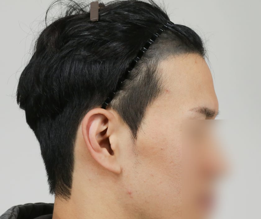BEFORE 남성 M자 · 구레나룻