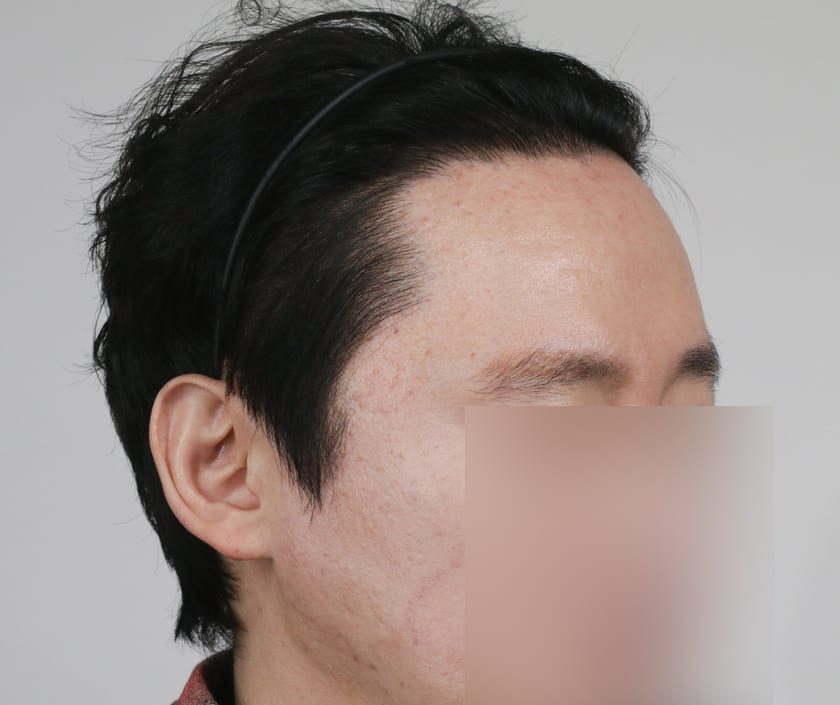 AFTER 남성 헤어라인 · 관자놀이