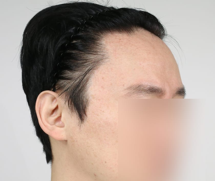 BEFORE 남성 헤어라인 · 관자놀이