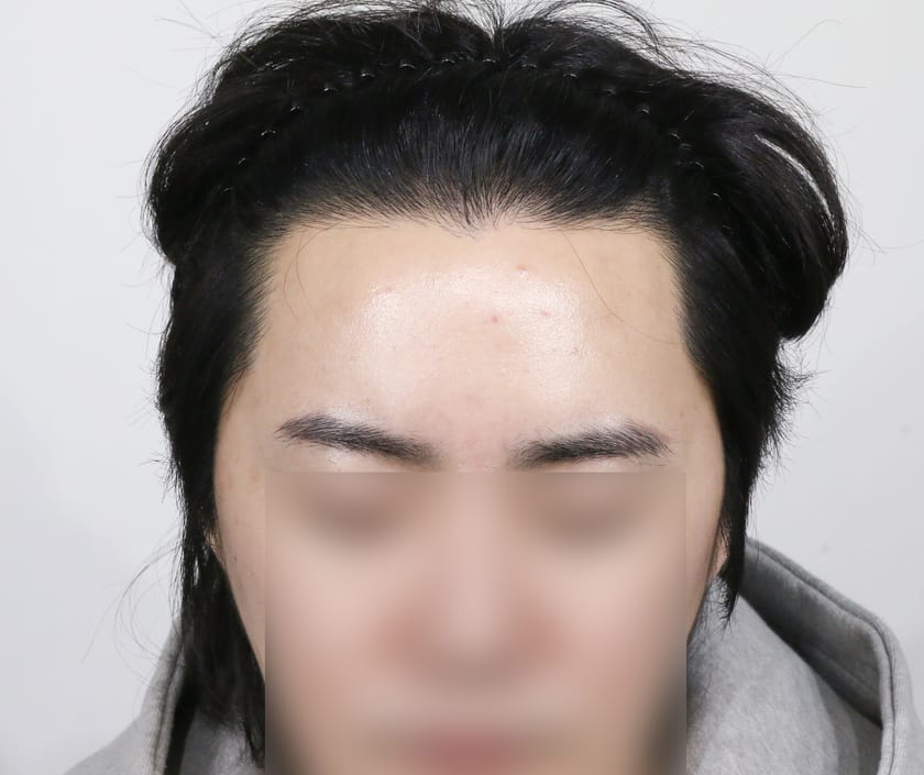 AFTER 남성 헤어라인 · 관자놀이 · 구레나룻