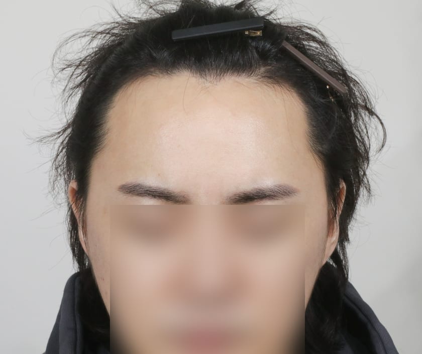BEFORE 남성 헤어라인 · 관자놀이 · 구레나룻