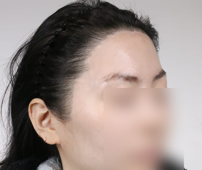 AFTER 재수술 · 비절개 박스컷 1,000모 · 흉터 커버