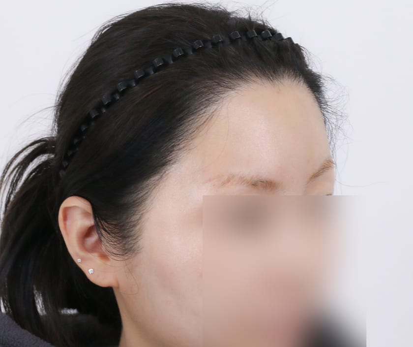 BEFORE 재수술 · 비절개 박스컷 1,000모 · 흉터 커버
