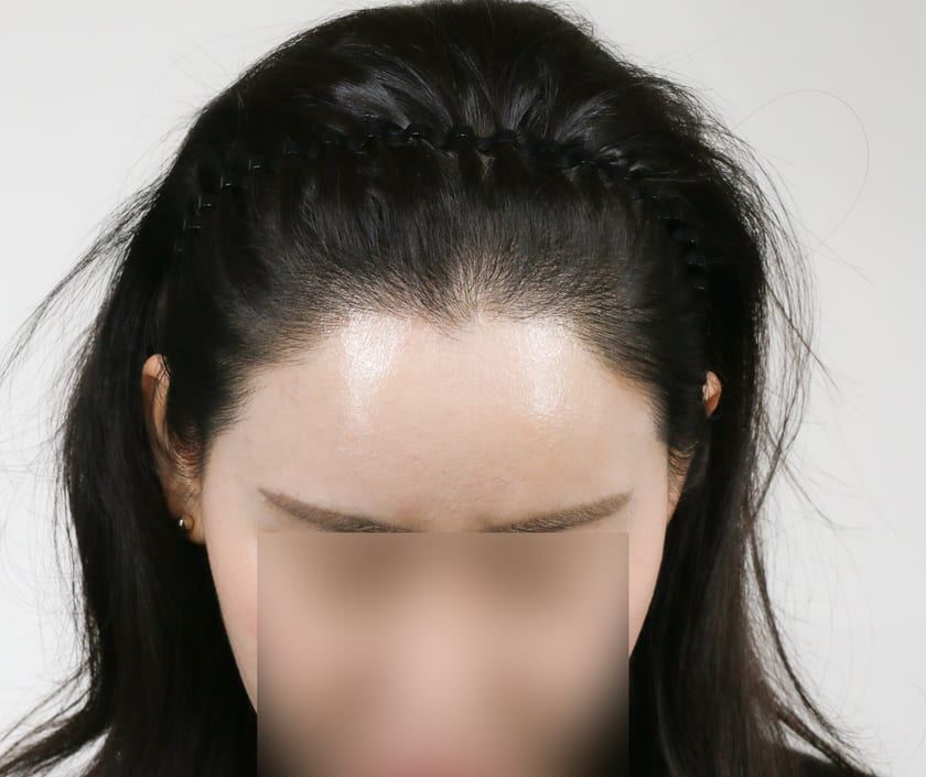 AFTER 재수술 · 비절개 박스컷 1,000모 · 헤어라인