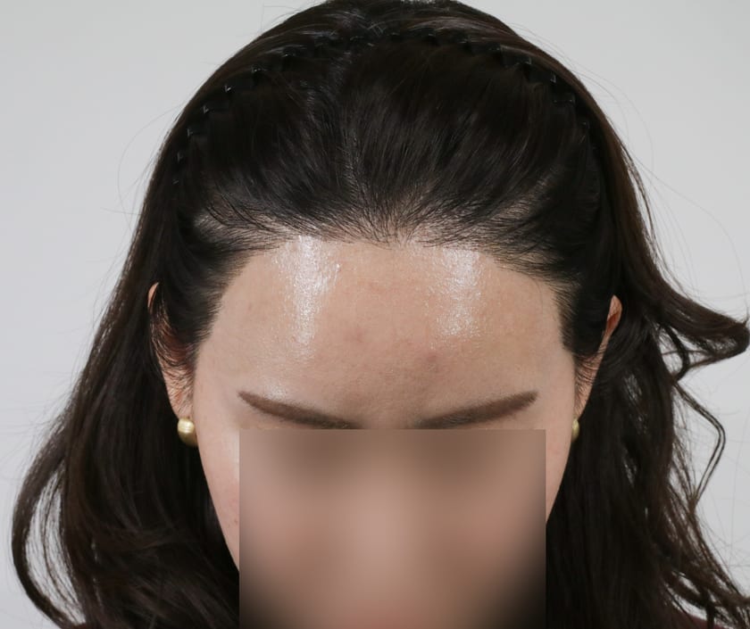 BEFORE 재수술 · 비절개 박스컷 1,000모 · 헤어라인