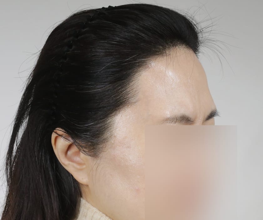 AFTER 재수술 1,400모 · 레이저 제모 병행 · 헤어라인