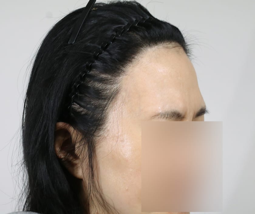 BEFORE 재수술 1,400모 · 레이저 제모 병행 · 헤어라인