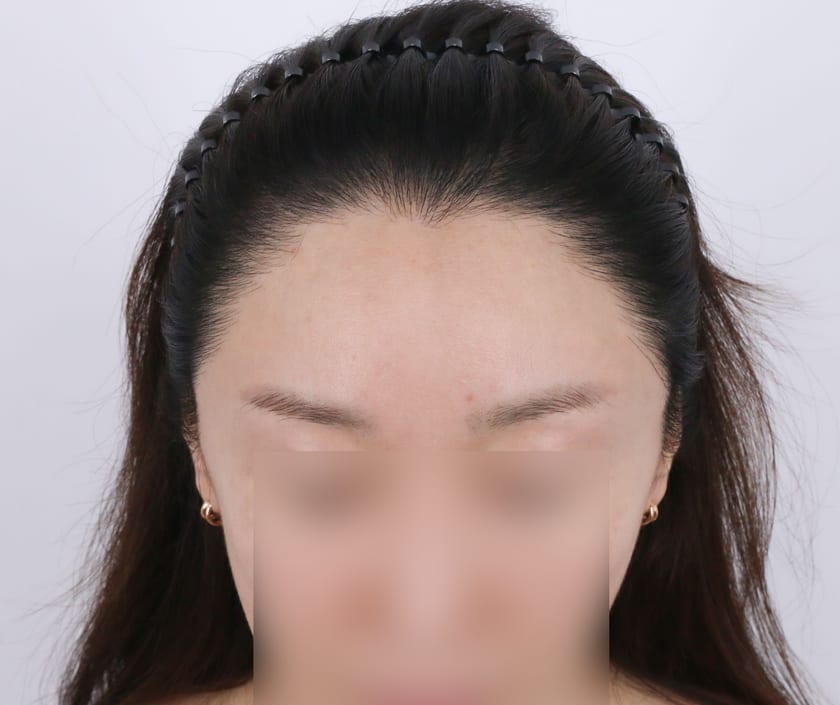 AFTER 재수술 1차 수술 뒤 · 2차 재수술