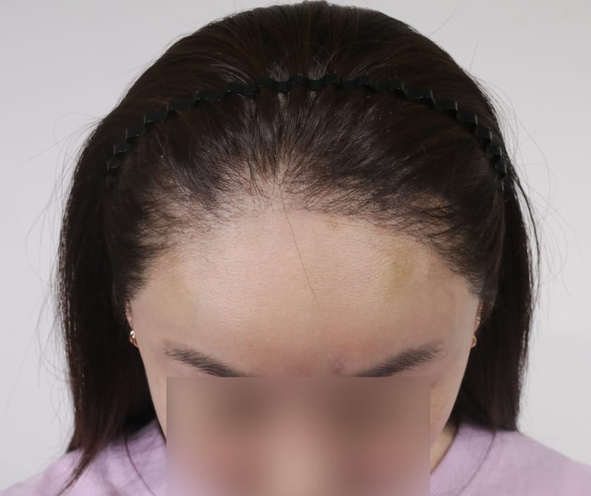 BEFORE 재수술 1차 수술 뒤 · 2차 재수술