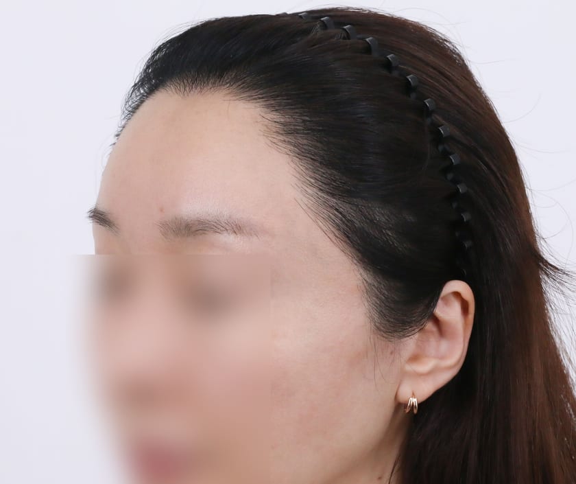 AFTER 재수술 3,000모 · 헤어라인 · 관자놀이