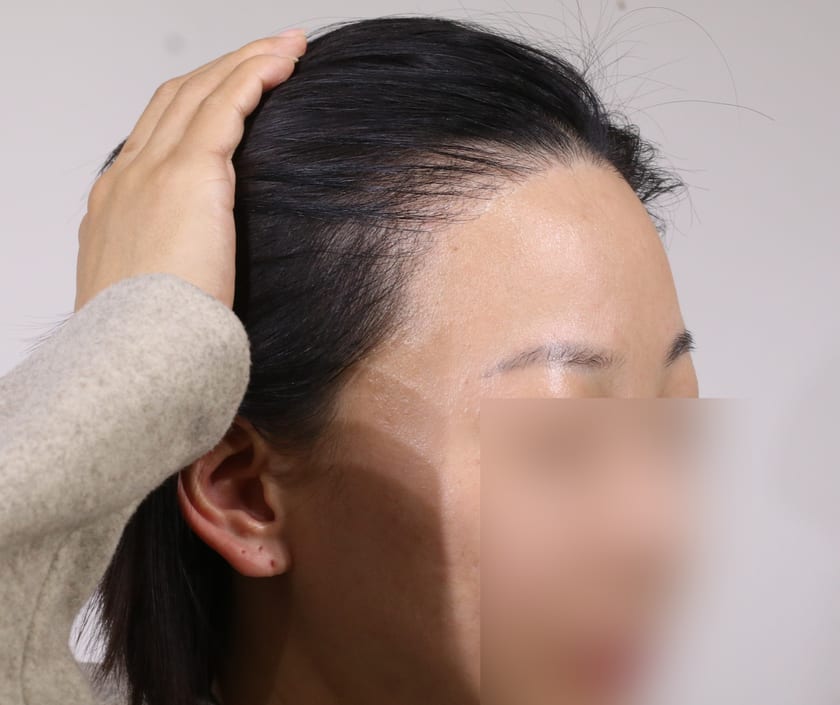 BEFORE 재수술 3,000모 · 헤어라인 · 관자놀이 · 구레나룻