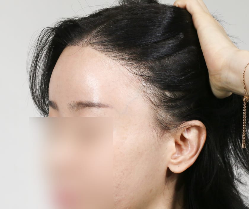 BEFORE 재수술 4,000모 · 헤어라인 · 관자놀이 · 구레나룻