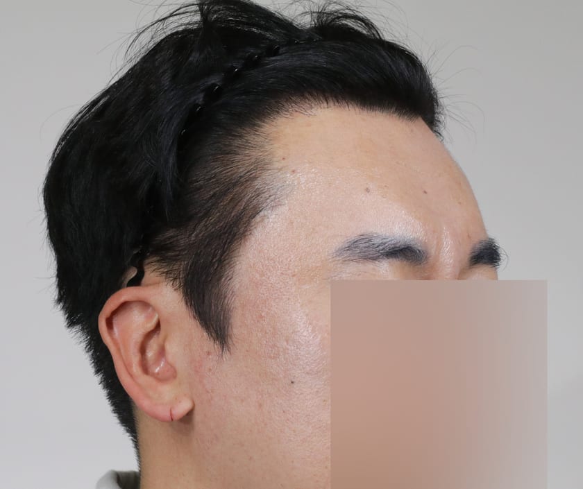 AFTER 재수술 · 비절개 700모 · 관자놀이 · 구레나룻