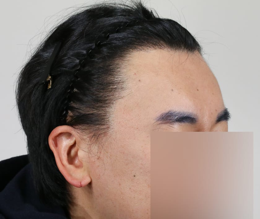 BEFORE 재수술 · 비절개 700모 · 관자놀이 · 구레나룻