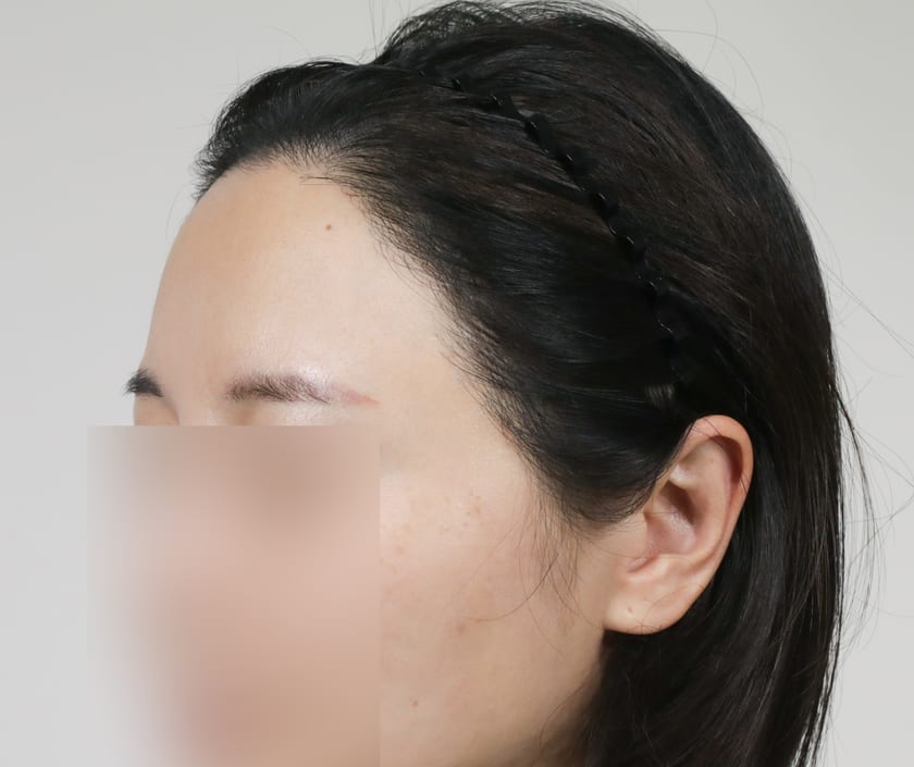 AFTER 재수술 · 절개 800모 · 헤어라인