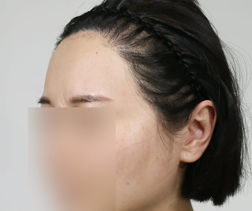 BEFORE 재수술 · 절개 800모 · 헤어라인