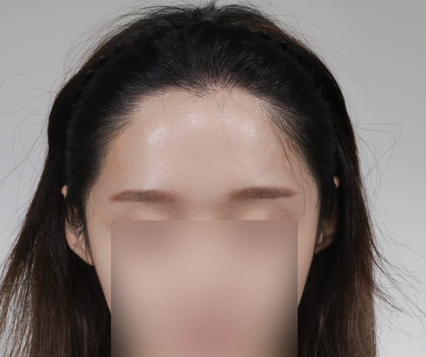 AFTER 재수술 헤어라인