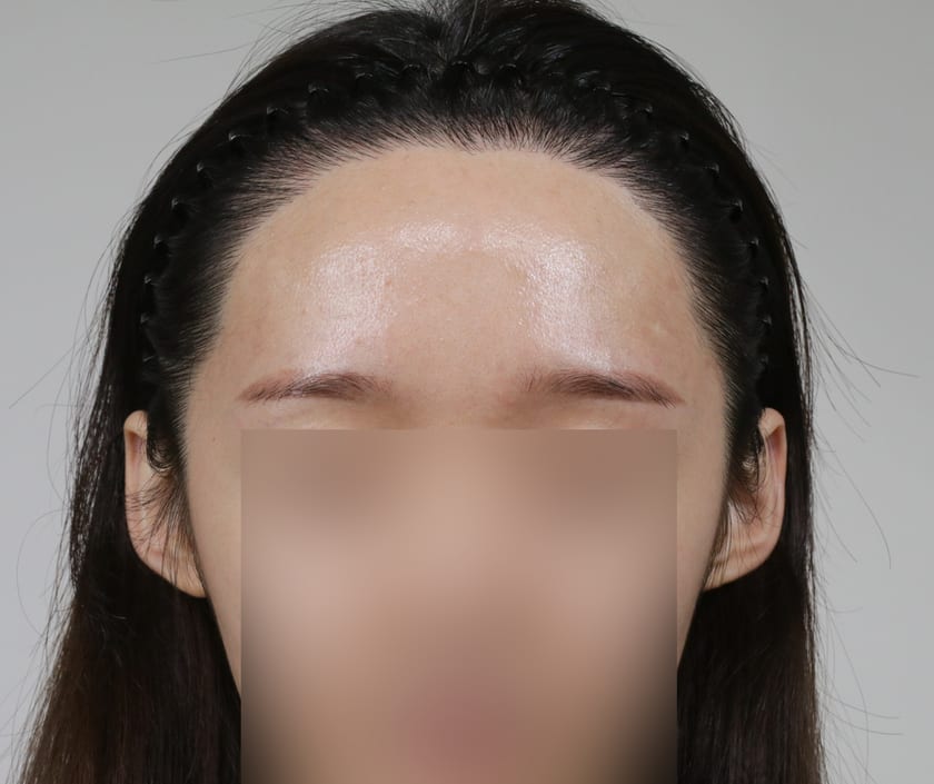 BEFORE 재수술 헤어라인