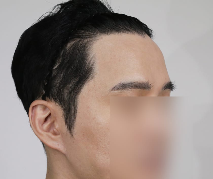 AFTER 재수술 헤어라인