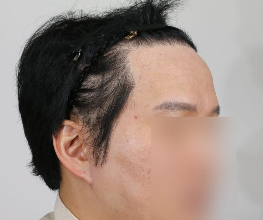 BEFORE 재수술 헤어라인