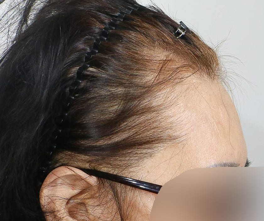 AFTER 흉터 이식 · 절개 2,500모 · 흉터 · 헤어라인 · 관자놀이