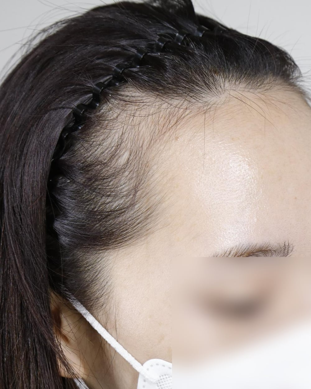 수술 전, 관자놀이 쪽이 비어 보이는 여성의 측면 헤어라인